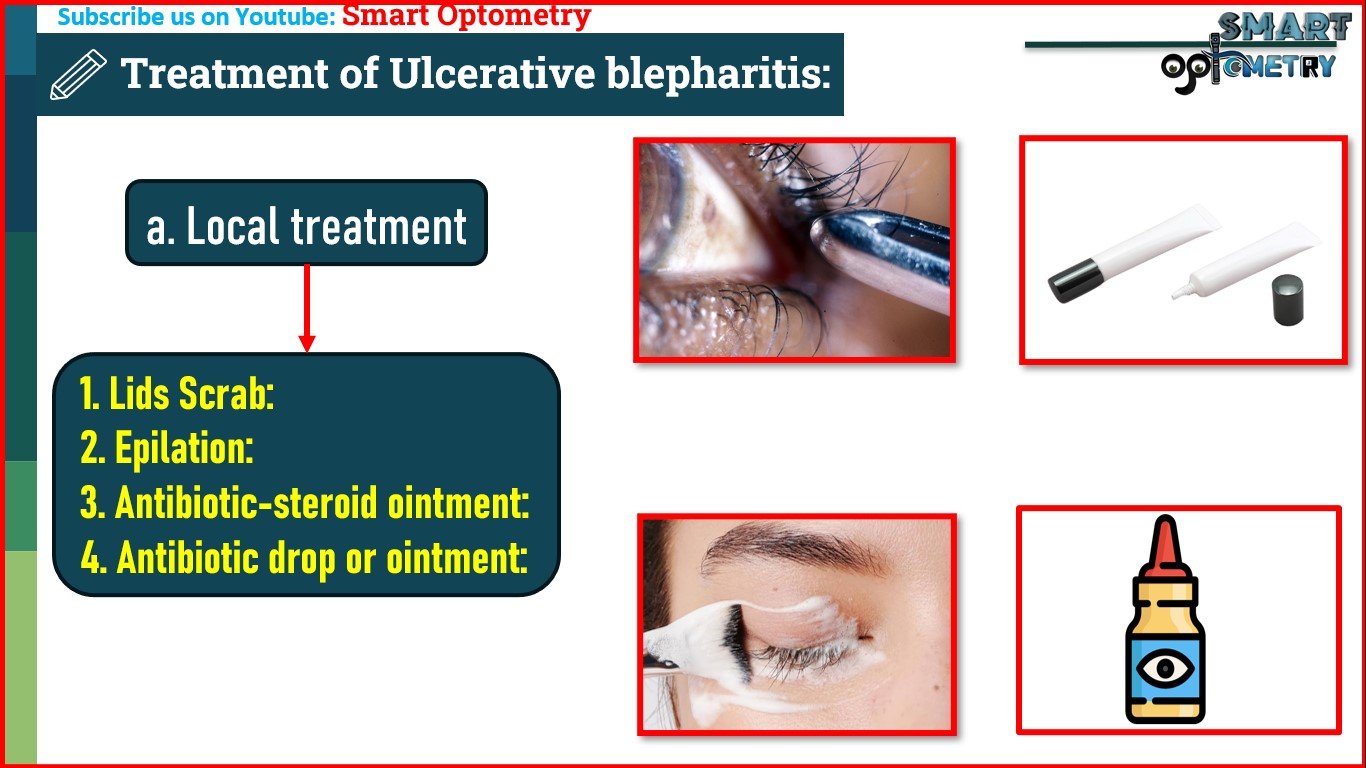 Blepharitis Introduction Causes Symptoms Signs Treatment 