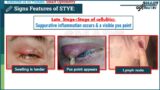 External Hordeolum or Stye- Everything you Need to Know - Smart Optometry