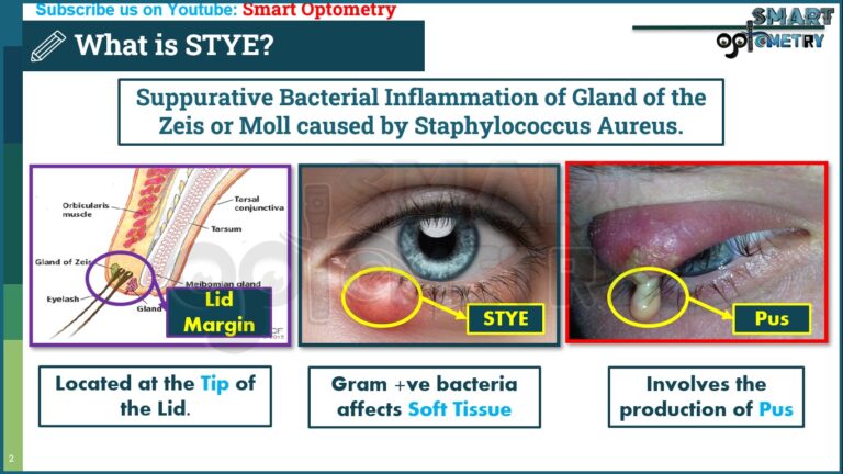 External Hordeolum or Stye- Everything you Need to Know - Smart Optometry