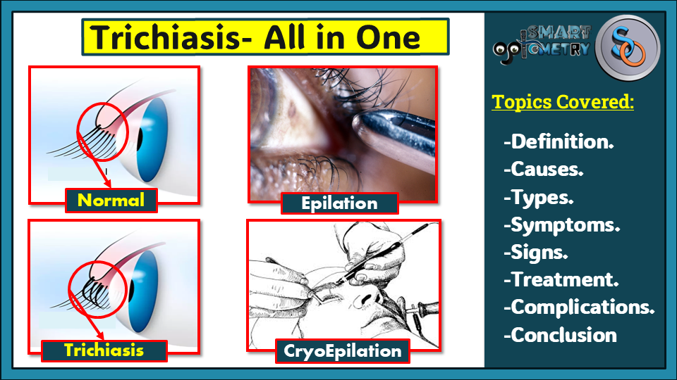 Trichiasis- Definition, Causes, Symptoms, Signs & Treatment.