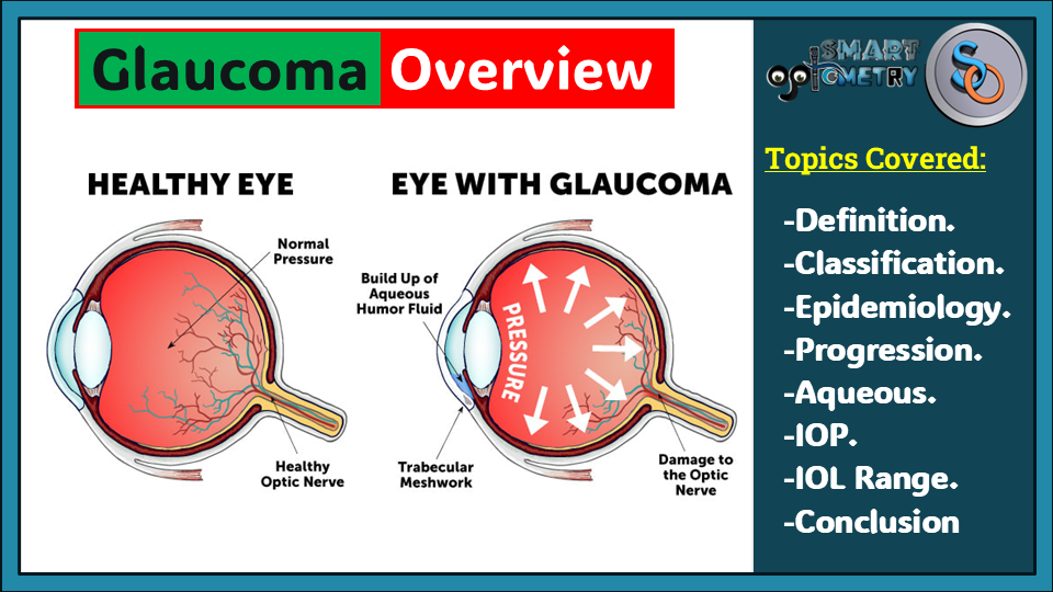 Overview of Glaucoma- The Silent Thief of Sight.